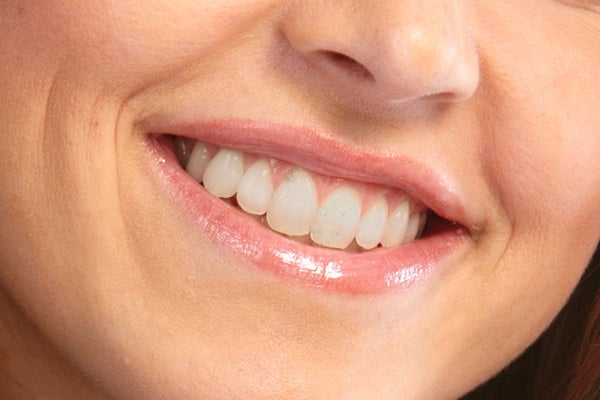 Fixed Teeth With Dental Implant Systems