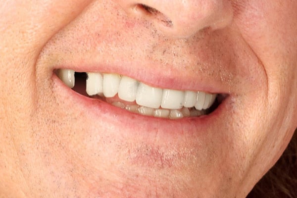 Fixed Teeth With Dental Implant Systems
