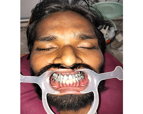 Dental Implant Systems