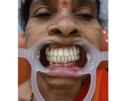 Dental Implant Systems